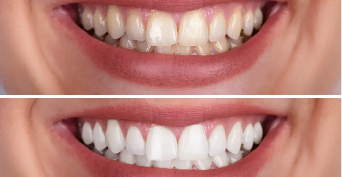 Teeth Whitening Roseville, CA