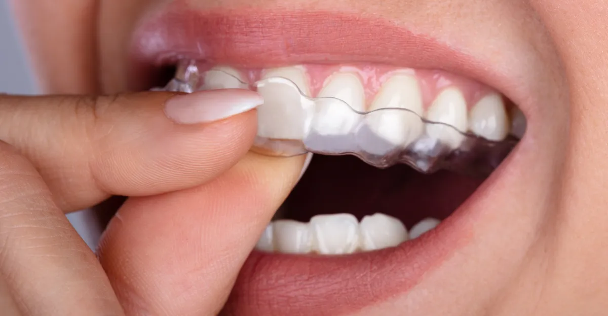 Invisalign in Roseville: How Clear Aligners Work