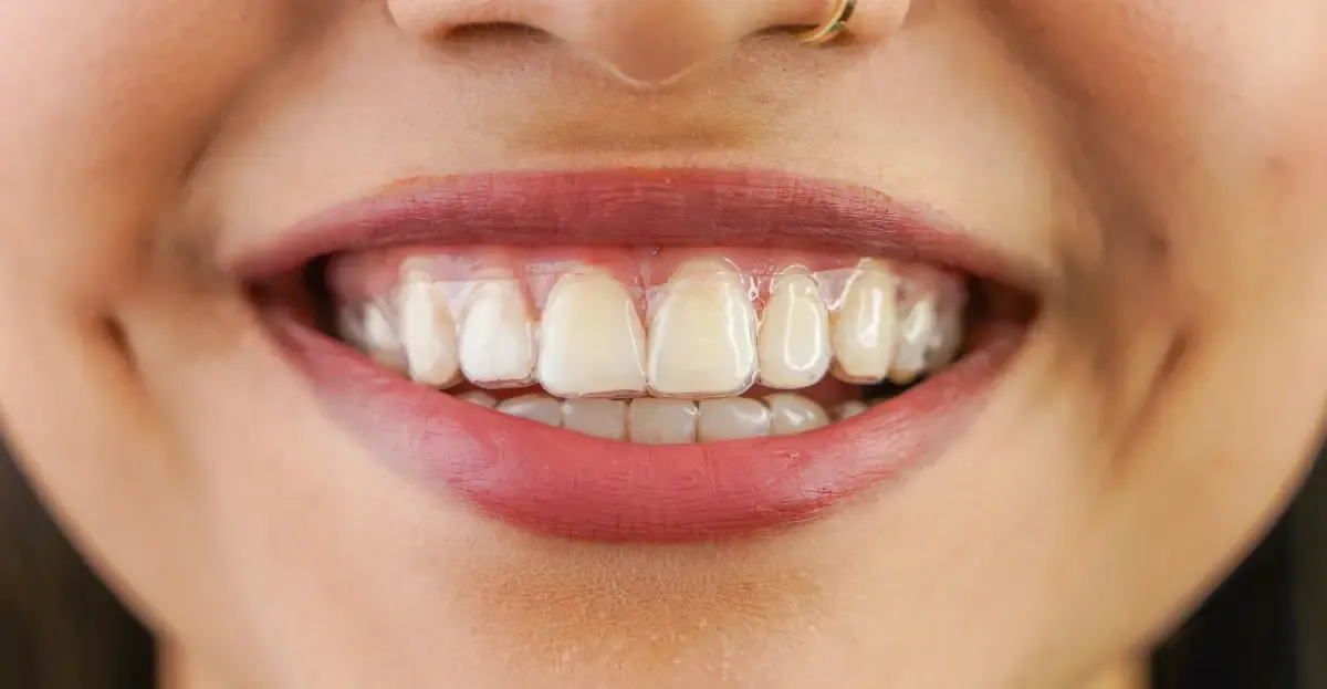 Invisalign Roseville, CA