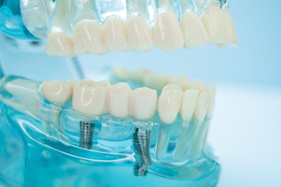 Dental Implants Roseville, CA