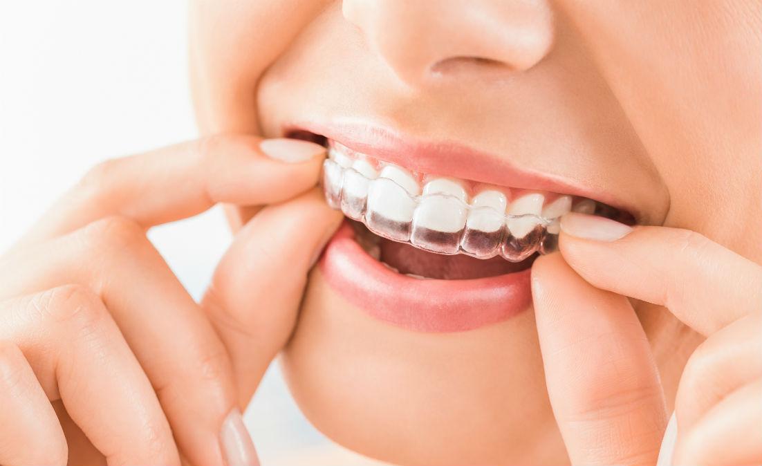 Invisalign Roseville, CA