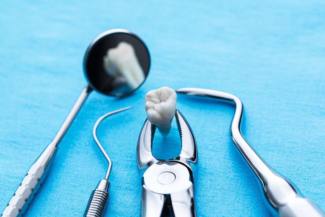 Tooth Extraction Roseville, CA