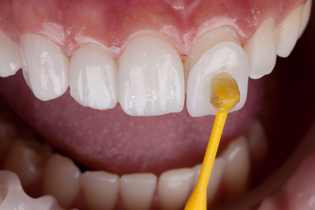 Veneers Roseville, CA