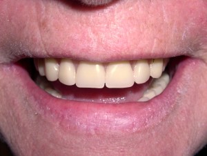 Dentures and denture services, Roseville Dentist, Yamamoto & Lee Family Dentistry in Roseville CA; image of dentures AFTER treatment.